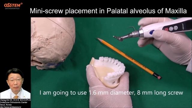 Ортодонтический винт 5  Альвеолярный гребень верхней ? смотреть онлайн