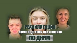 Подтяжка лба и висков: опыт восстановления по дням