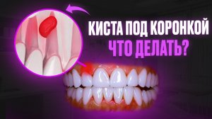 КИСТА ПОД КОРОНКОЙ ЗУБА? ПОСЛЕДСТВИЯ И ЧТО ДЕЛАТЬ?
