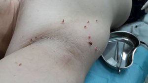 Удаление папиллом радиоволновым методом