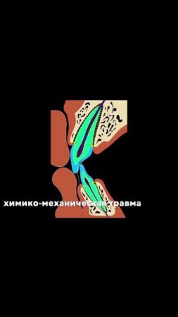 Травма переднего зуба как последствие мезиального дрейфа в процессе роста лица #shorts #стоматология