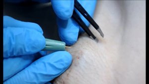 Клиника косметологии «8 ЧУДО» - Электроэпиляция