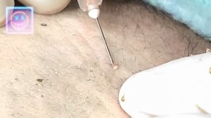 Извлечение угрей и прыщей. Черные точки. Удаление угрей