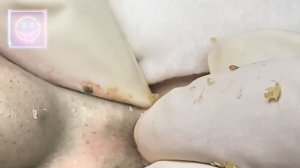 Извлечение угрей и прыщей. Черные точки. Удаление угрей