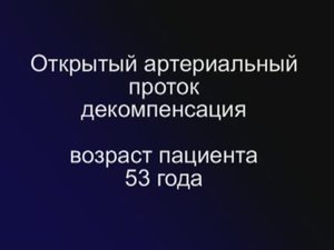 ОАП декомпенсация 53 года