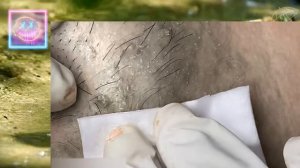 Извлечение угрей и прыщей 08