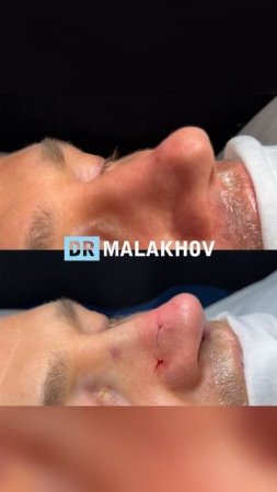 Мужская риносептопластика ⚡️