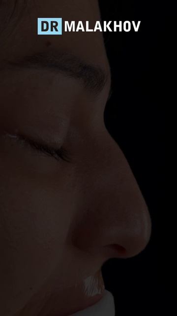 Первичная риносептопластика 👃🏼
ДО и НА ОПЕРАЦИОННОМ столе
