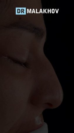 Первичная риносептопластика 👃🏼
ДО и НА ОПЕРАЦИОННОМ столе