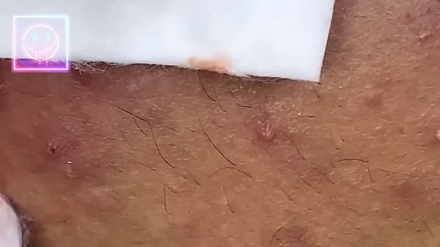Извлечение угрей и прыщей. Черные точки. Удаление угрей и выдавливание прыщей на лице и теле.