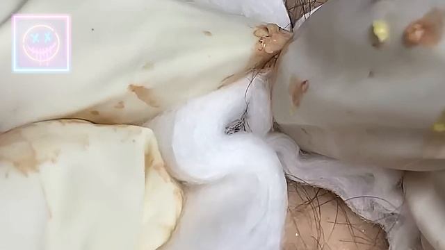 Извлечение угрей и прыщей. Черные точки. Удаление угрей и выдавливание прыщей на лице и теле.