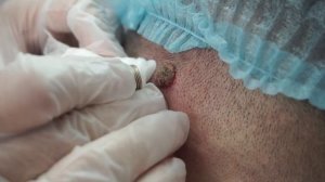 Удаление Папилламотозного Невуса Диодным Лазером