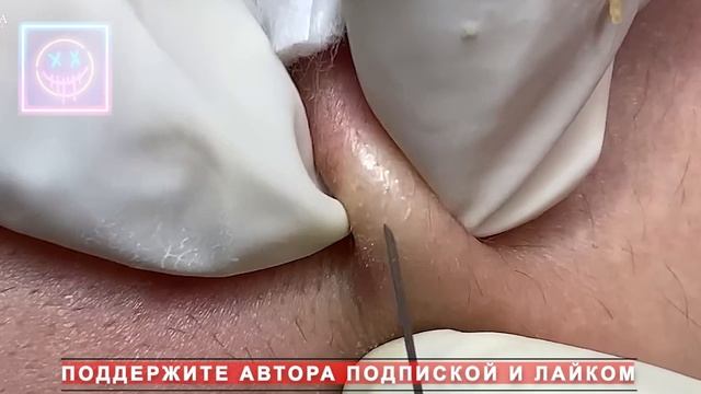 Извлечение угрей и прыщей. Черные точки. Удаление угрей и выдавливание прыщей на лице и теле.