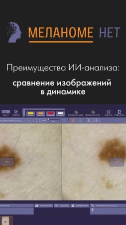 Дерматоскопия, которой можно доверять — с поддержкой ИИ