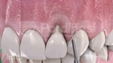 Лечение рецессии десны