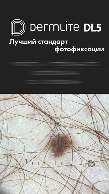 DermLite DL5 — новый стандарт фотофиксации в дерматологии