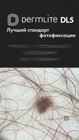 DermLite DL5 — новый стандарт фотофиксации в дерматологии