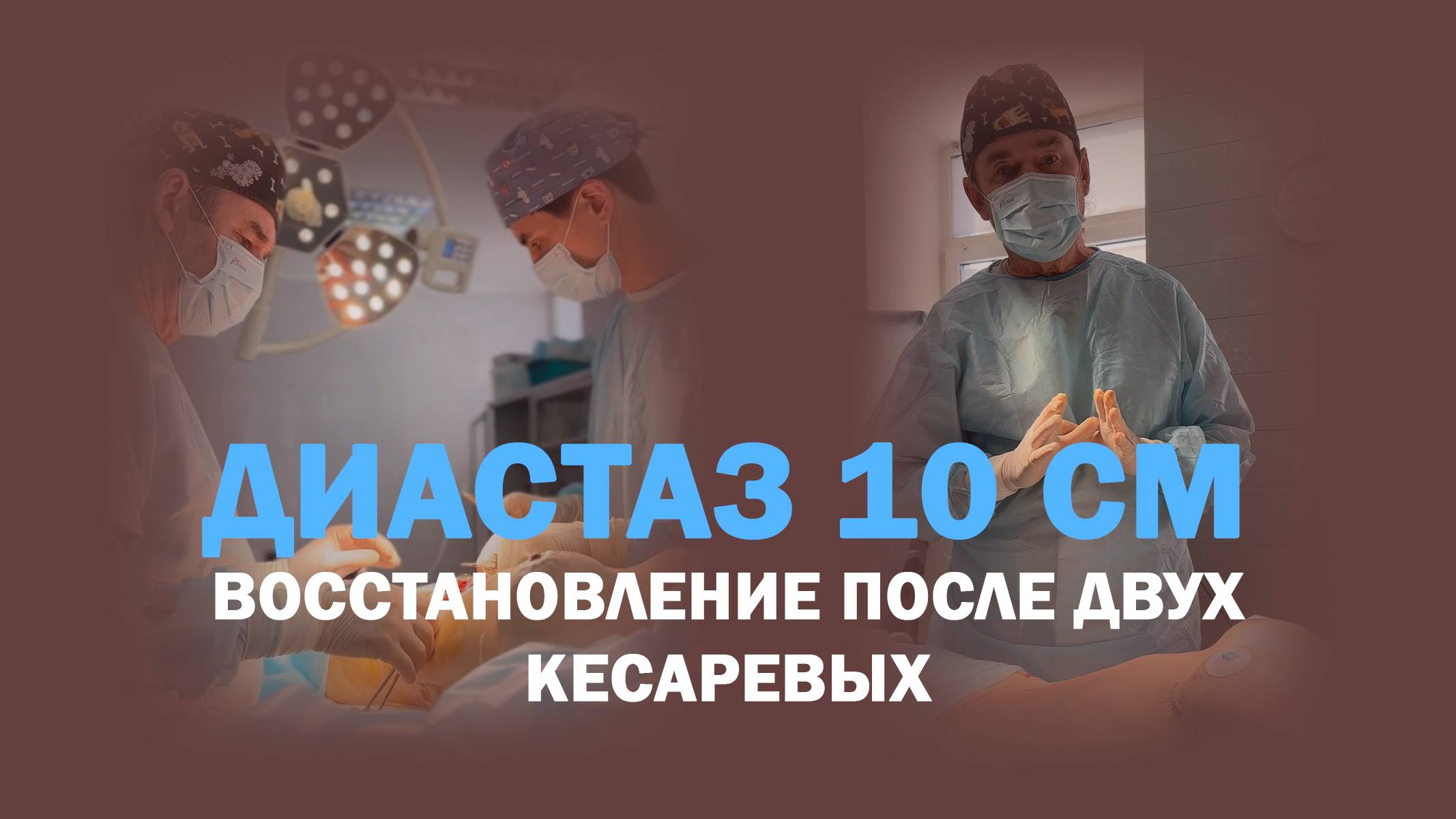 Фигура после двух родов: маммопластика + абдоминопластика в одной операции