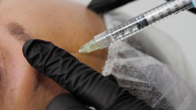 Ботулотоксин в косметологии. Верхняя треть лица