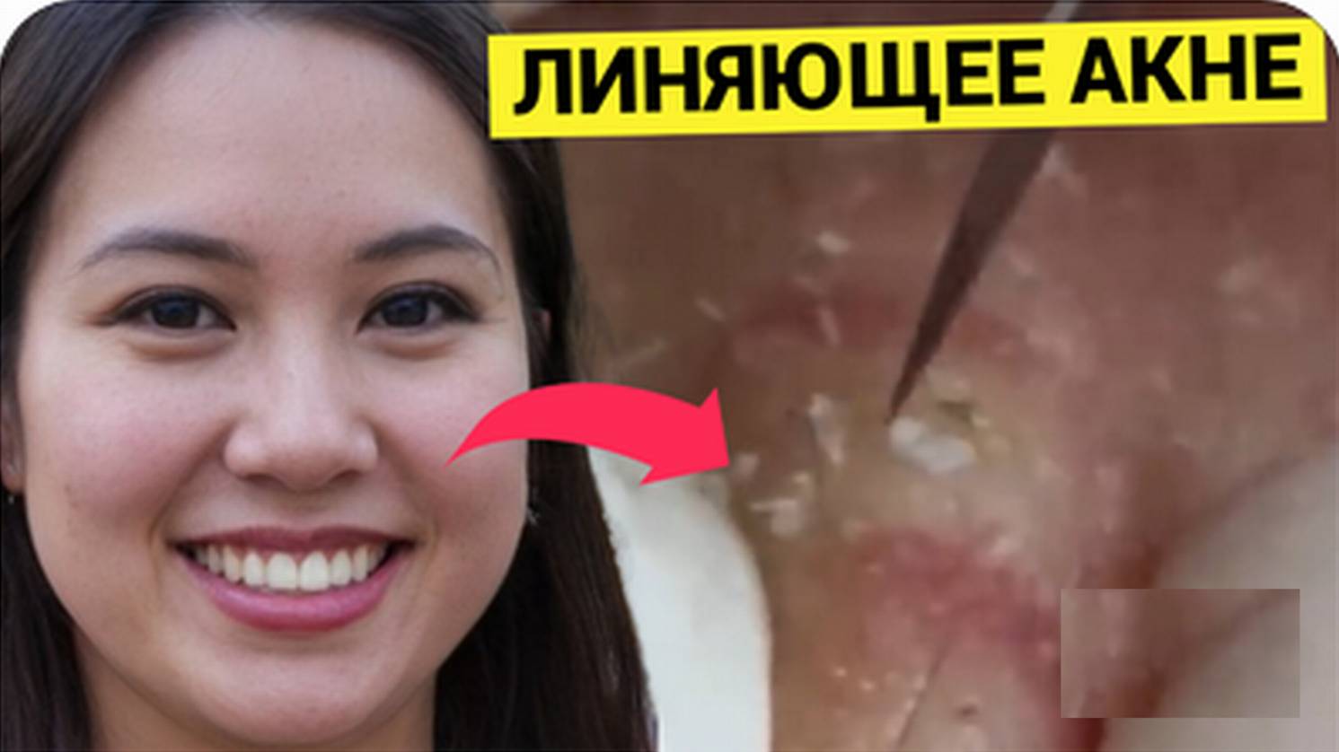 Толстокожий ЛИНЯЮЩИЙ Гость, Прилёг Почиститься от Прыщей и Комедонов
