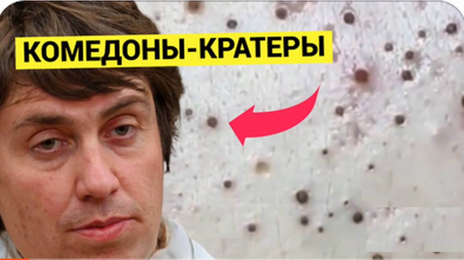 Прыщи и Комедоны как КРАТЕРЫ на Луне. Уникальный Гость. Попал в хорошие руки КОСМетолога. Выдавил вс