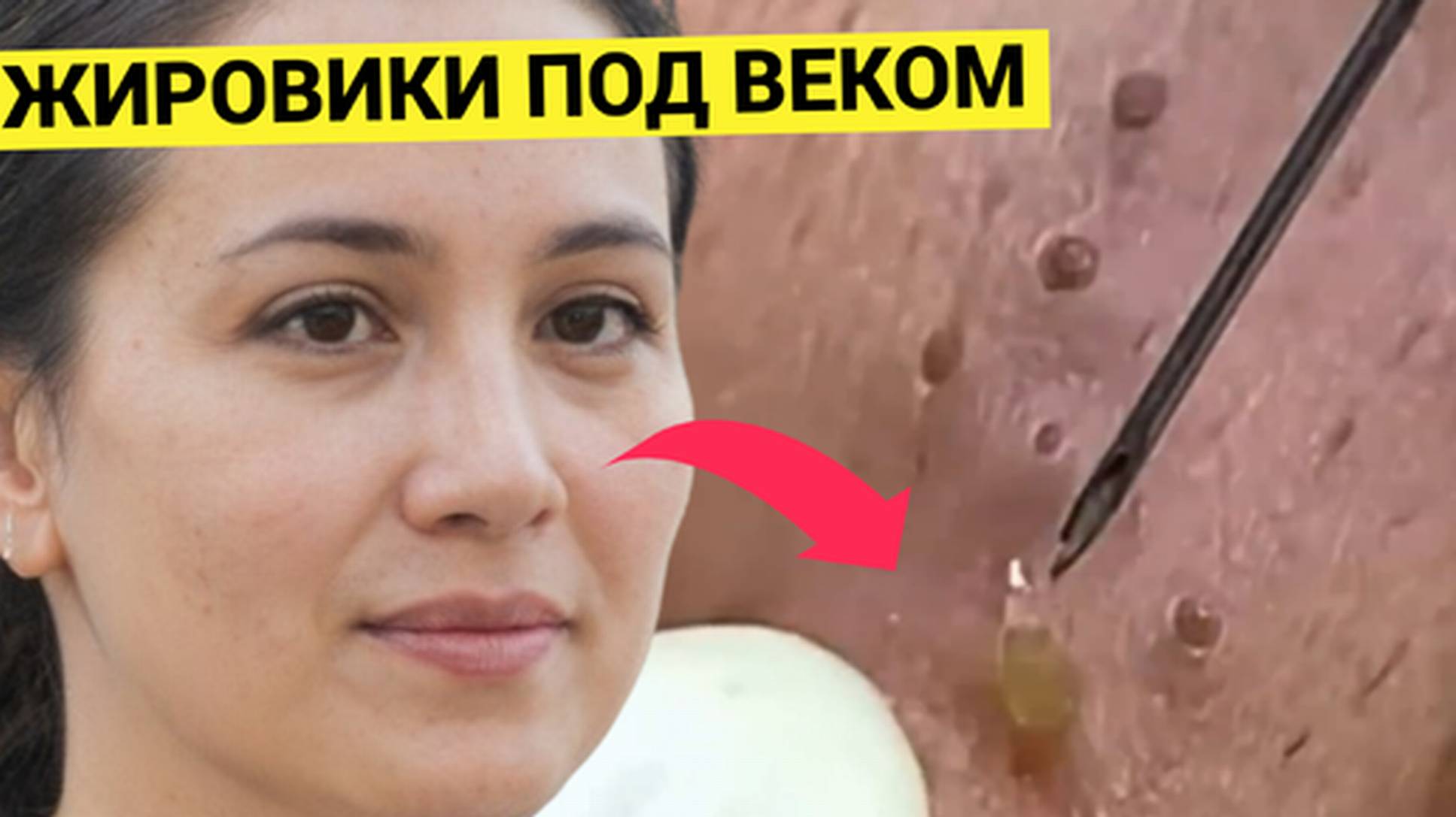 Ресницы Нарастила, а Жировики с Угрями как у Старика Выдавливать приходится. Но повезло с косметолог