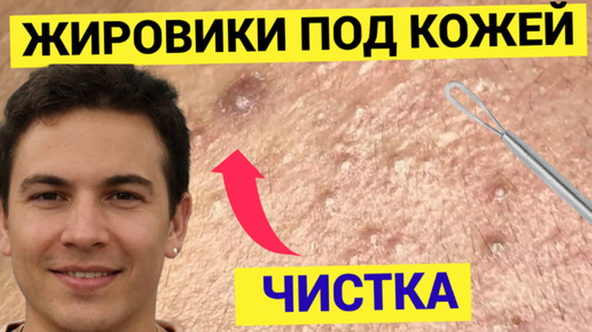 Шагреневая от Прыщей Кожа, Сальники накопились и Выдавливаются. Мастер аккуратен и очистил лицо чётк
