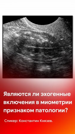 УЗИ в гинекологии: являются ли эхогенные включения в миометрии признаком патологии?