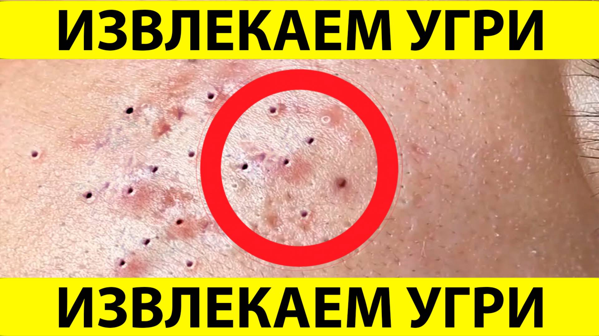 Очистка лица от угрей и акне. Выдавливание прыщей. Удаление черных точек и комедонов.