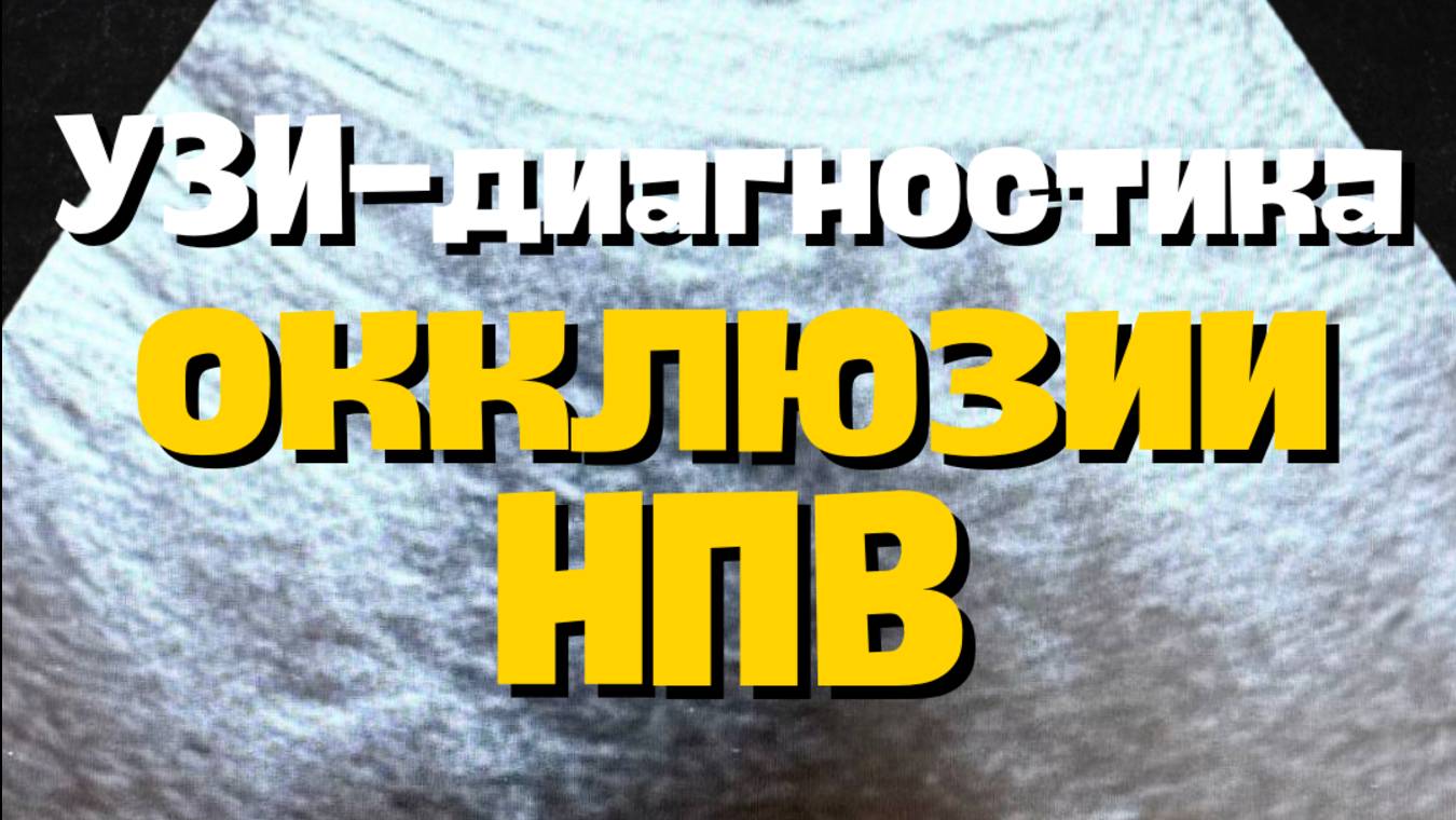 Ультразвуковая диагностика хронической окклюзии нижней полой вены