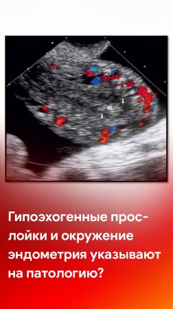 Гипоэхогенные прослойки миометрия и гипоэхогенное окружение эндометрия - это патология?