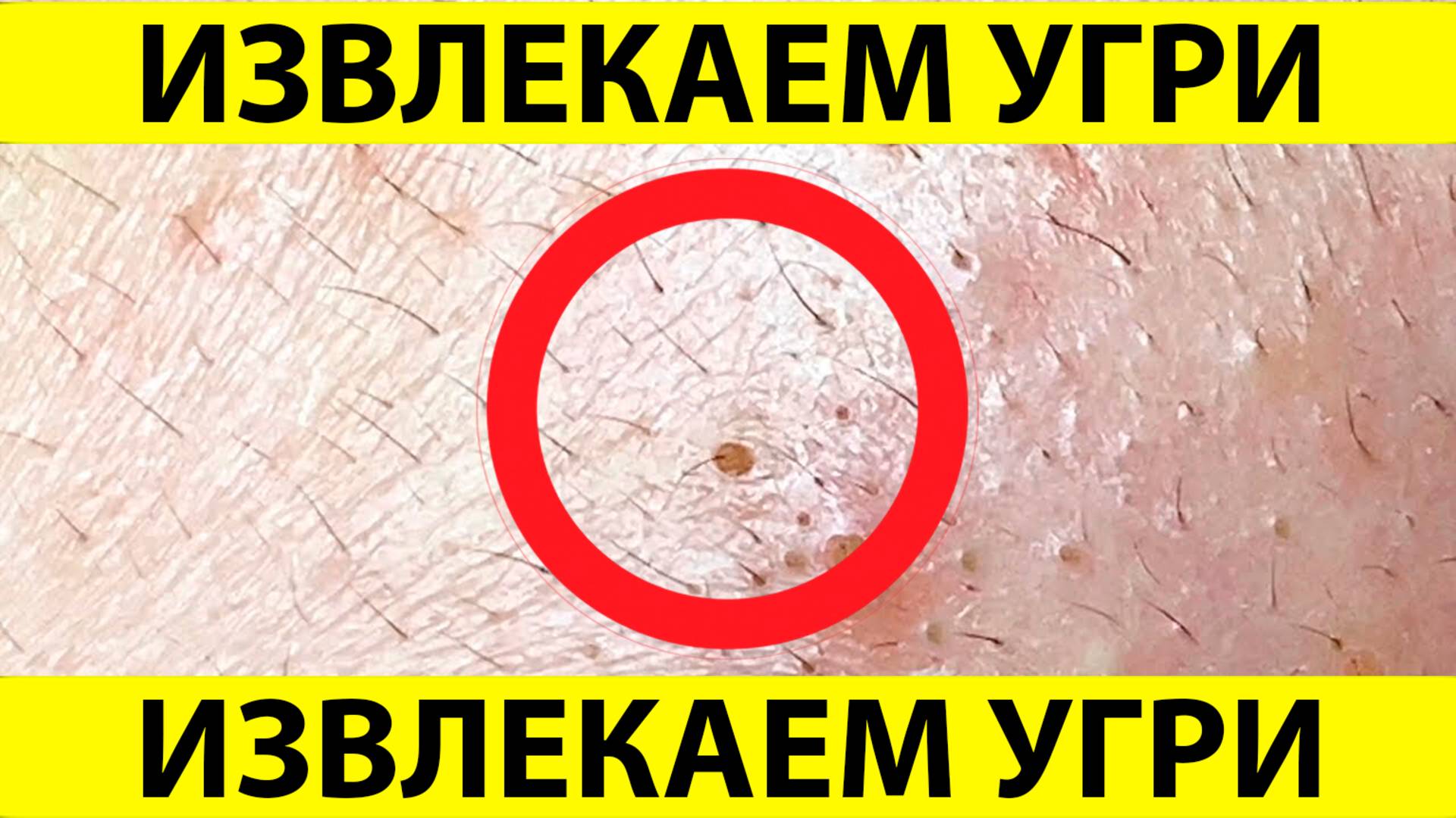 Очистка лица от угрей и акне. Выдавливание прыщей. Удаление черных точек и комедонов.