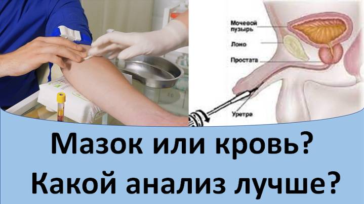 Мазок или кровь? Какой анализ лучше?