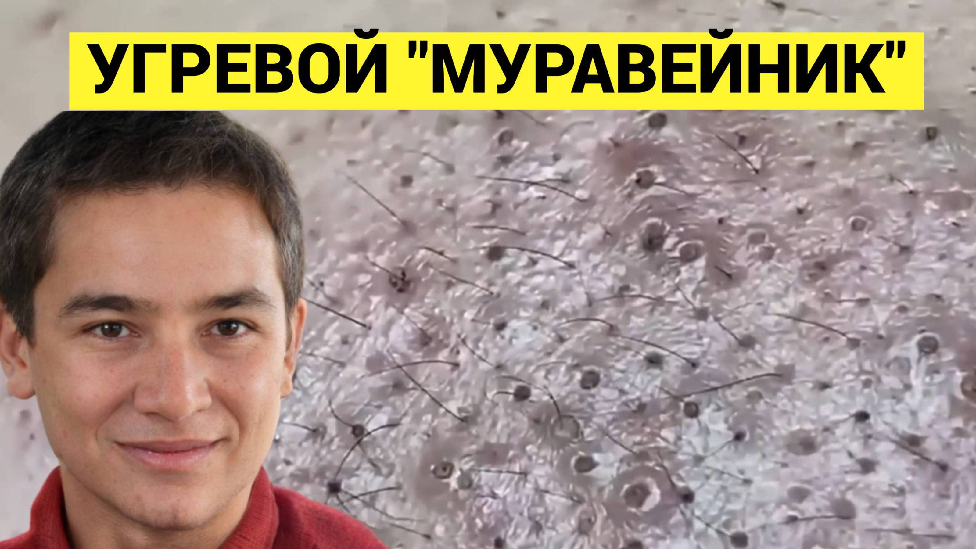 Кто Лучше Выдавит Прыщи и Угри. 3 Косметолога соревнуются в очистке Кожи Лица от Комедонов и Черных