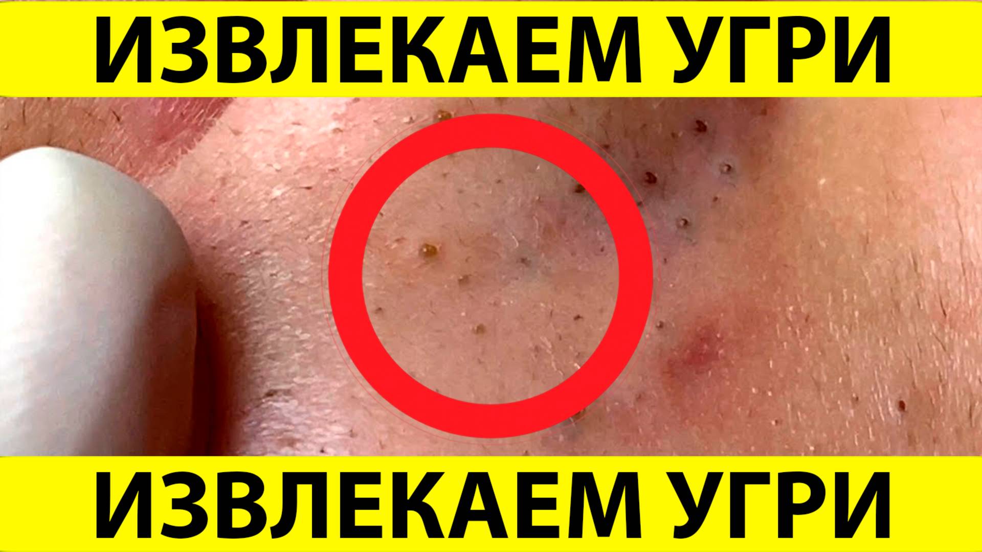 Очистка лица от угрей и акне. Выдавливание прыщей. Удаление черных точек и комедонов.