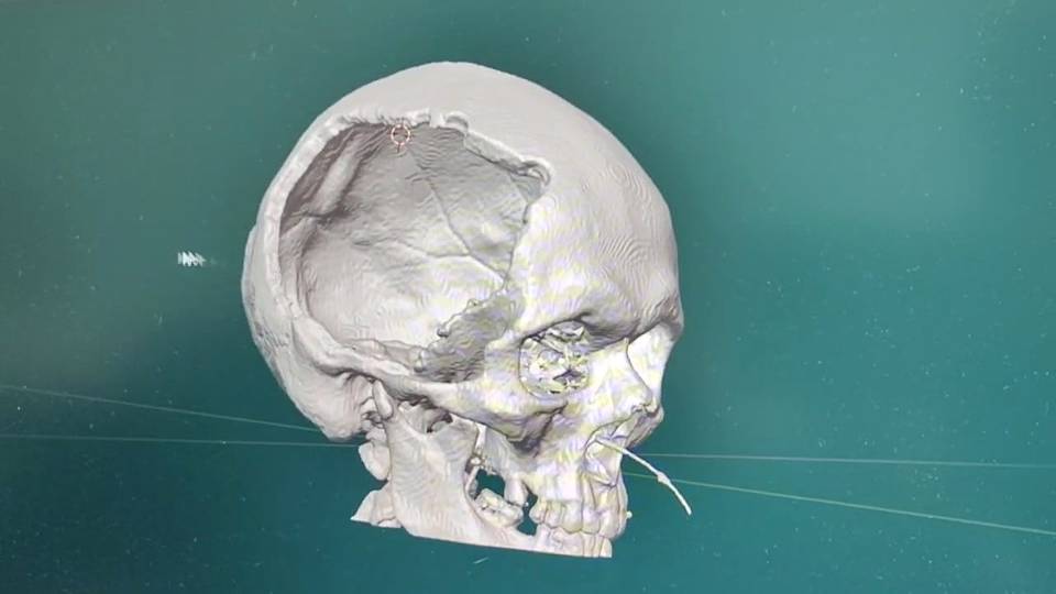 Сургутские врачи с помощью 3D-технологии восстановили череп пациента