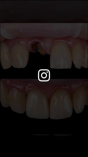 Пришел без зуба🦷 , ушёл с зубом 😁