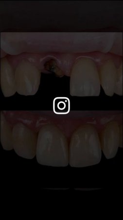 Пришел без зуба🦷 , ушёл с зубом 😁