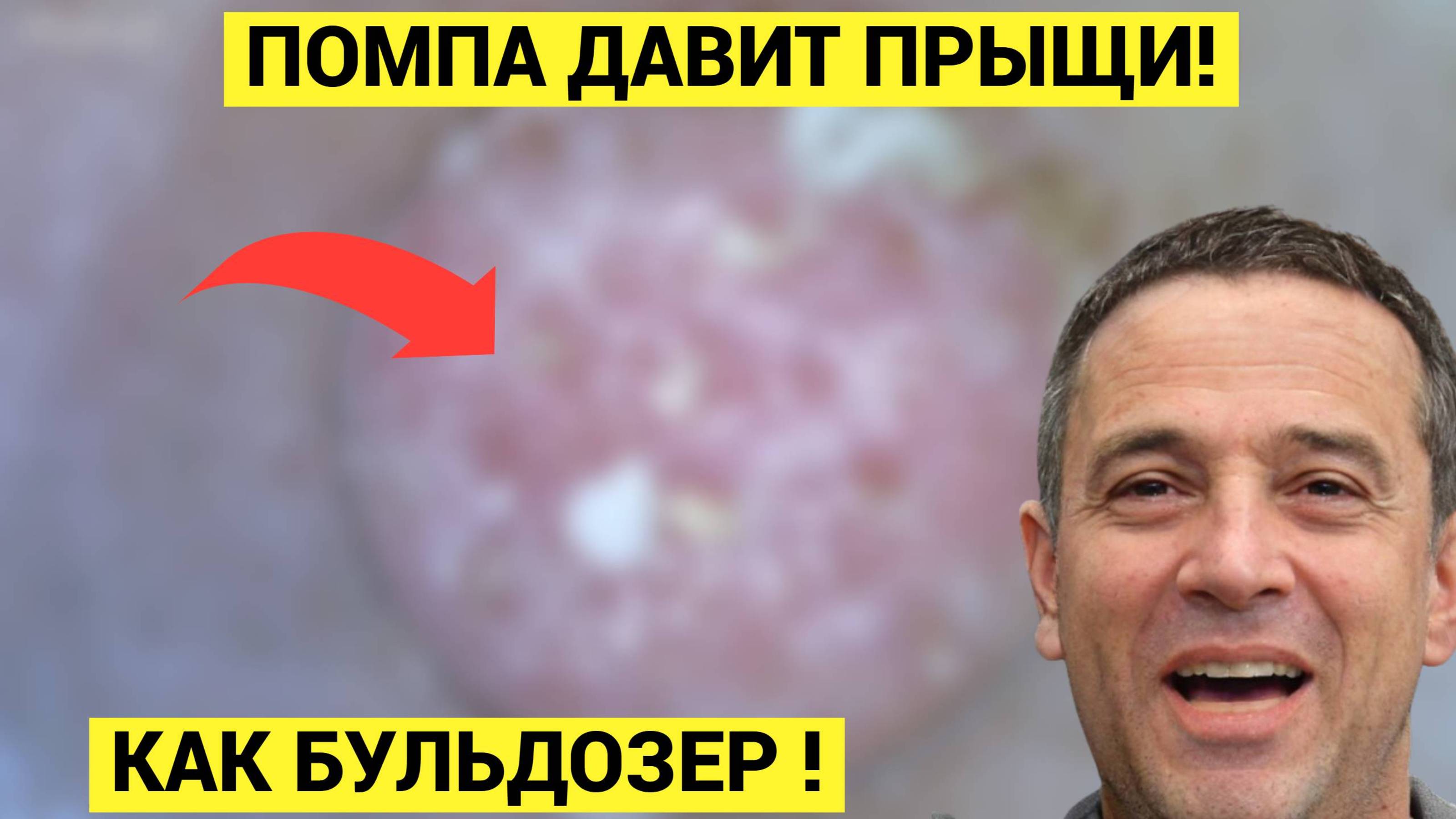 КОМЕДОНЫ и УГРИ Высасываются Помпой НАГЛУХО, чисто как у младенца