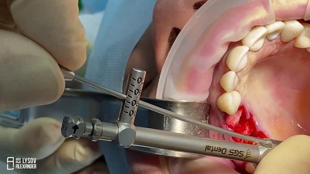 Немедленная нагрузка на имплант P5D SGS Dental с использованием WHS – проф. Александр Лысов, Россия