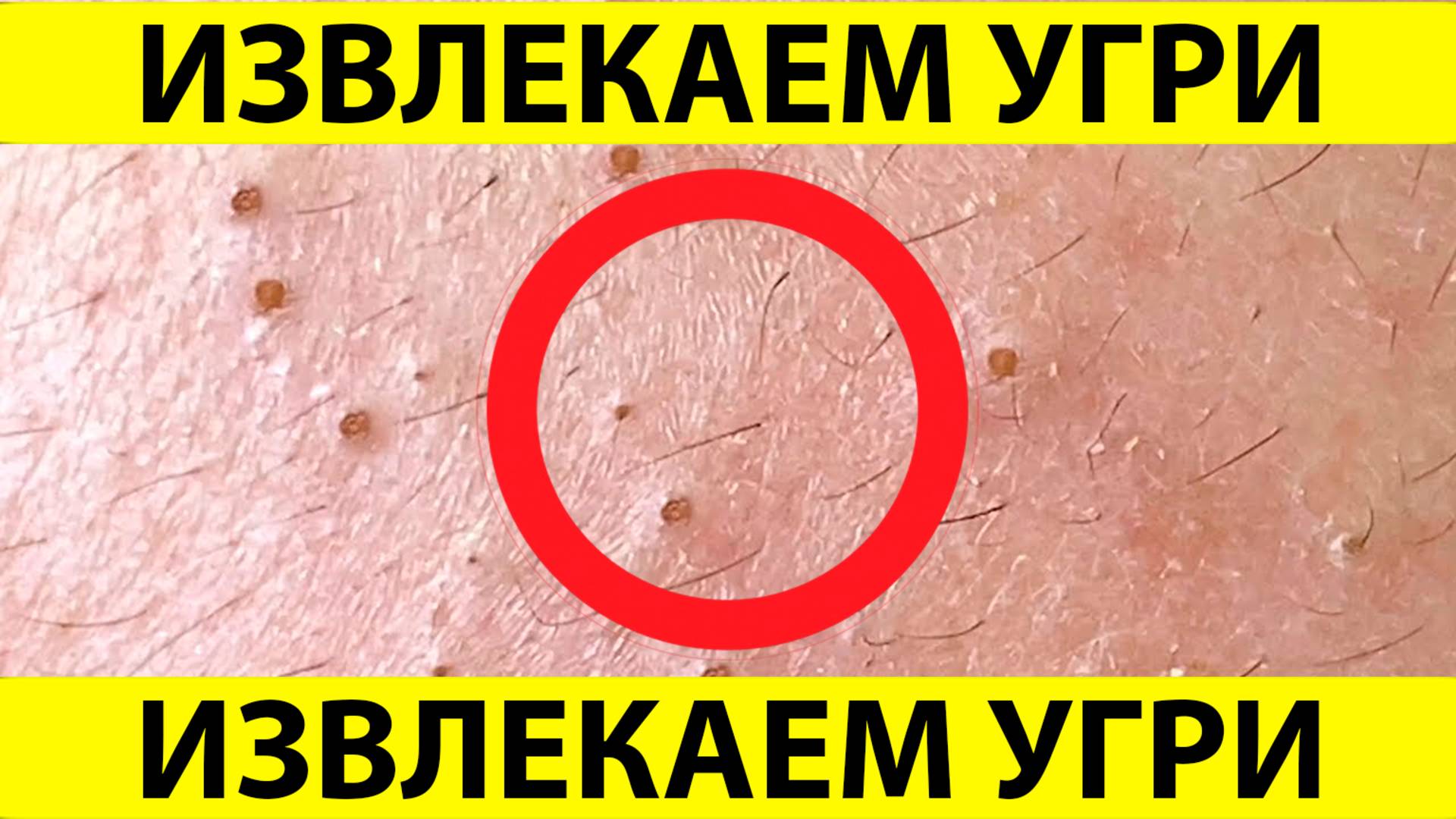 Очистка лица от угрей и акне. Выдавливание прыщей. Удаление черных точек и комедонов.