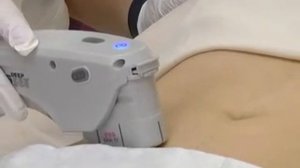 Безоперационная подтяжка лица, SMAS-лифтинг, HIFU