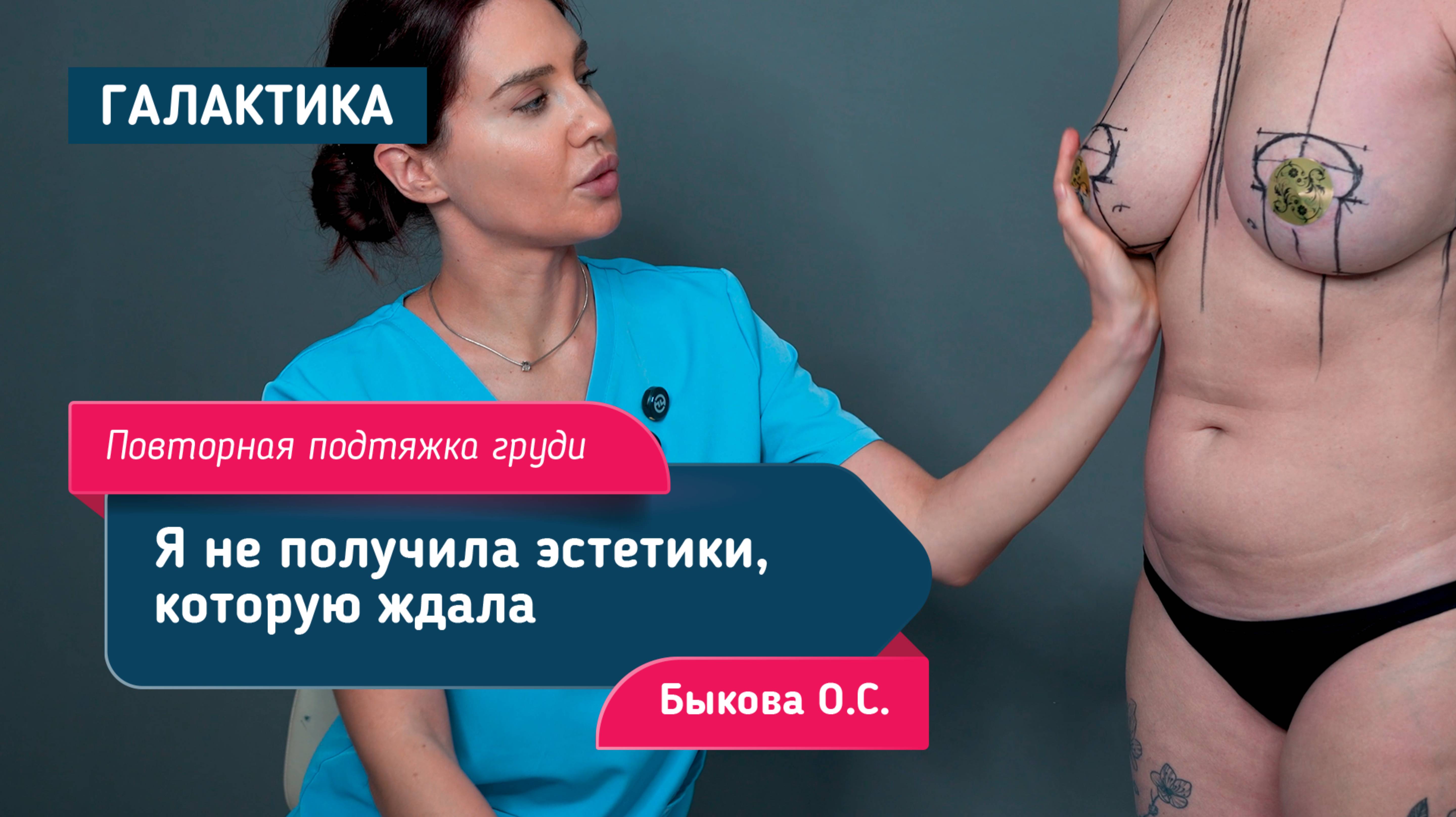 Повторная маммопластика: птоз, замена имплантов Motiva на Mentor | Хирург Быкова