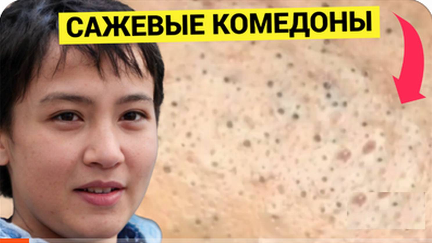 Комедоны САЖЕНЦЫ на Обзоре. Оригинальное Выдавливание Черных Точек без сбора на Перчатку