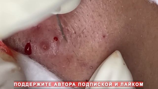 Извлечение угрей и прыщей. Черные точки. Удаление угрей и выдавливание прыщей на лице и теле.