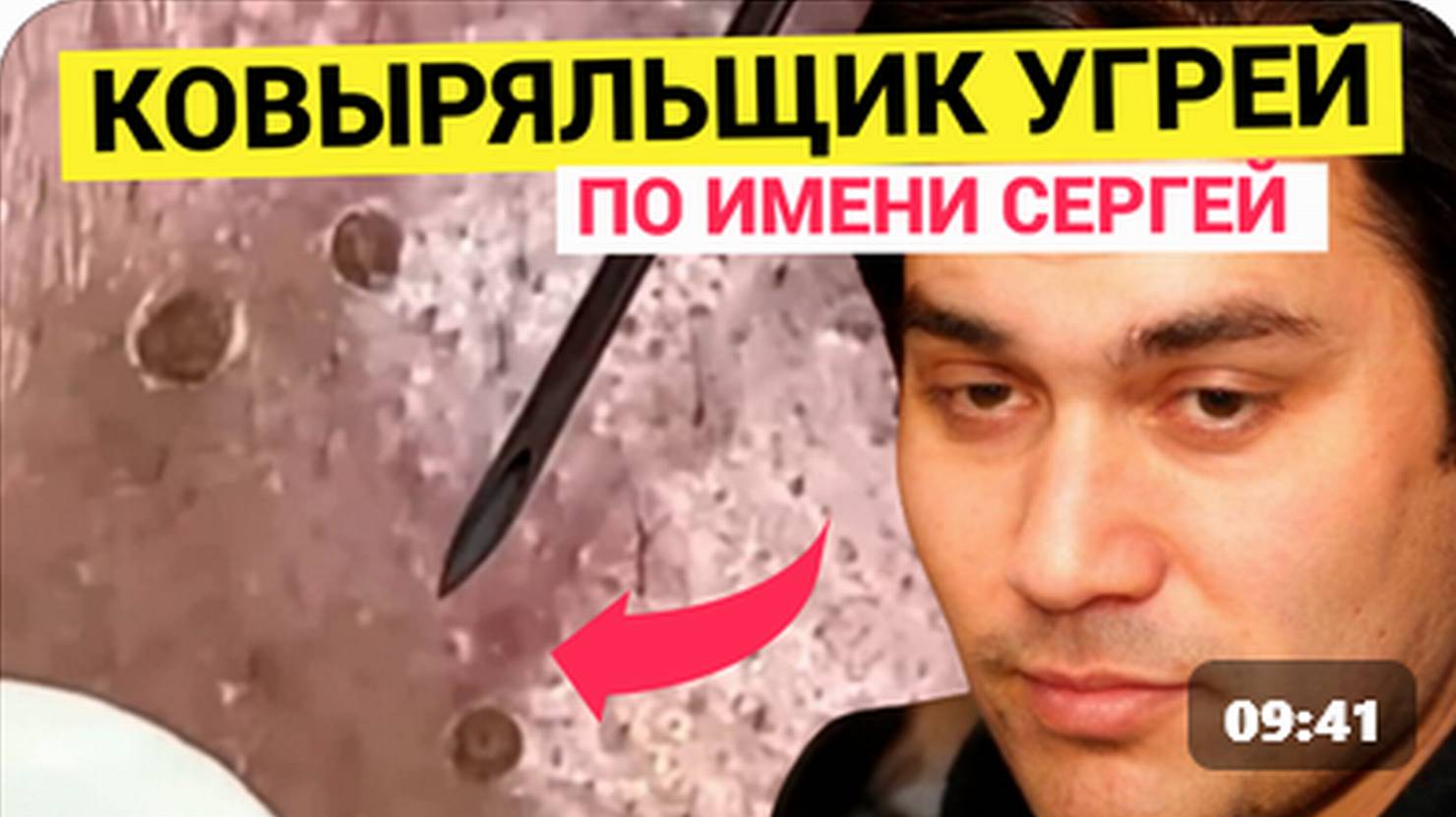 Лоснящаяся кожа в Комедонах и Угрях подвергается СОМНИТЕЛЬНОМУ ковырянию от подМастерья. Поход к кос