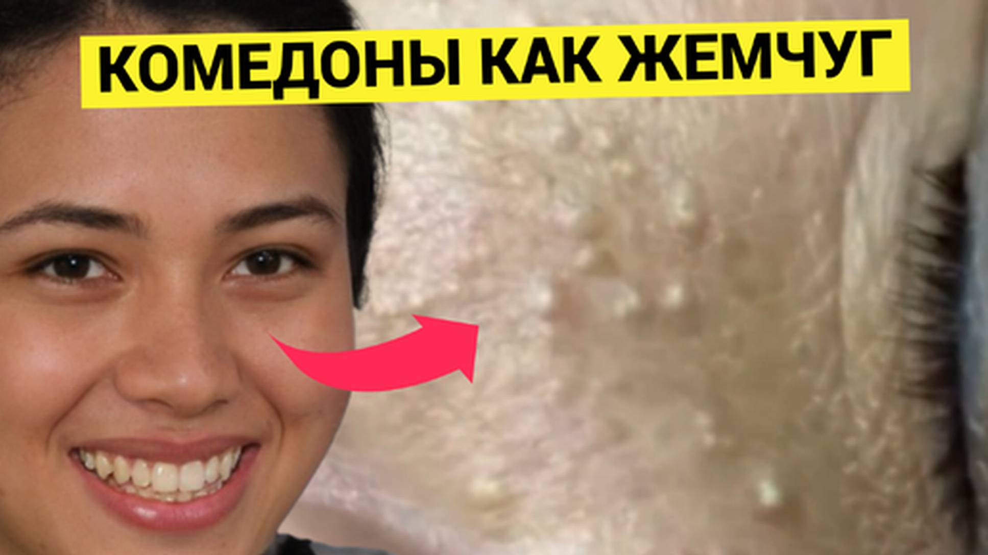 ВОЗВРАЩЕНИЕ Комедонов _Кукурузных_ или Выдавливаем Прыщи-_Жемчуг_ Снова. Релакс Обзор