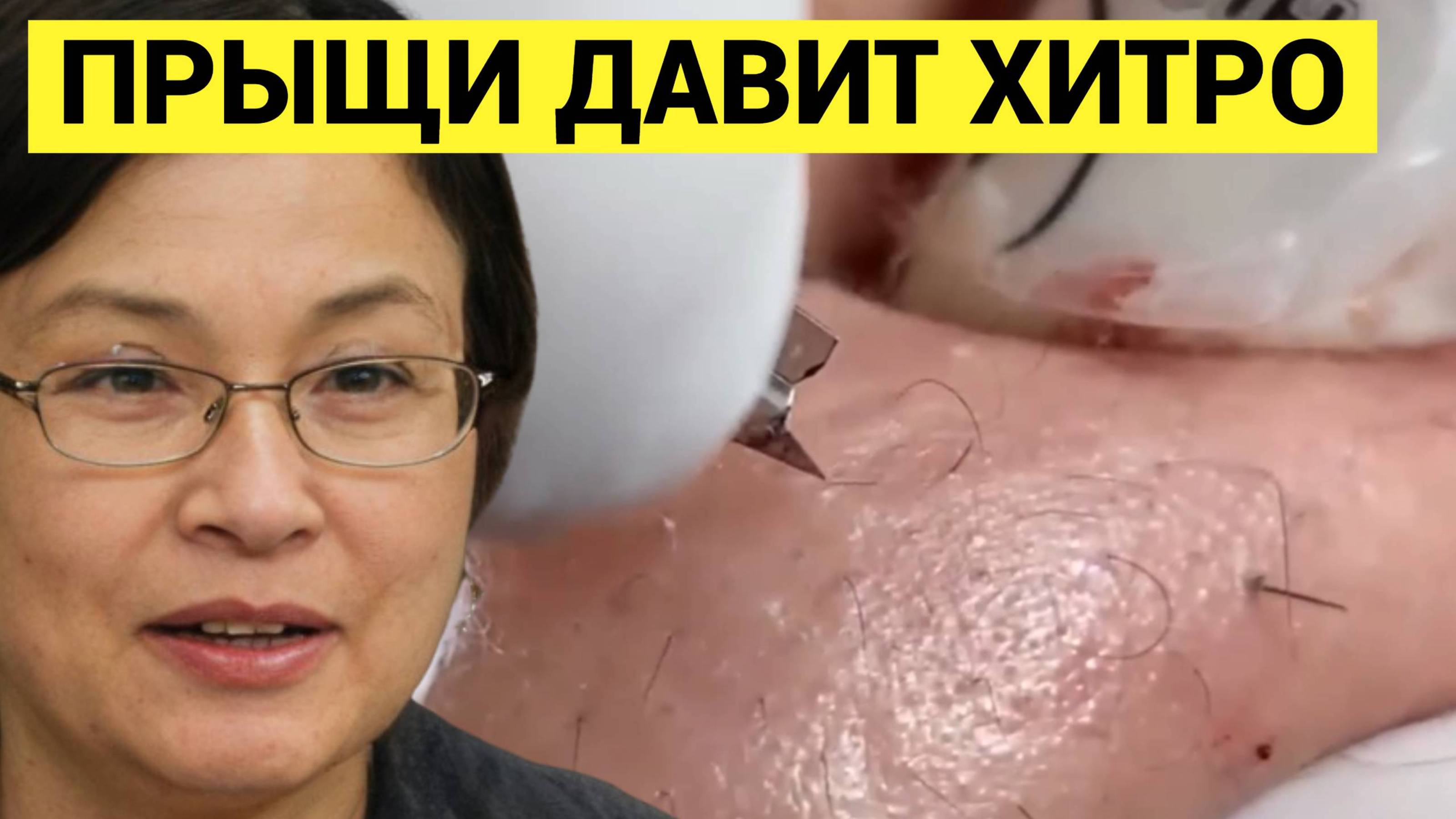 Выдавливание Прыщей  ТВОРОЖНЫХ интересным способом! Аж очки надел! Плюс история трогательная