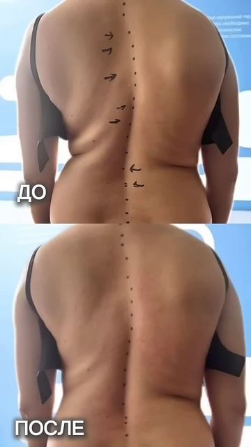 Результат работы со сколиозом. #костоправмосква #здоровьеспины #сколиоз #осанка