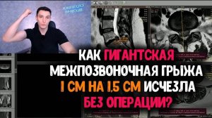Грыжа гигант 1см на 1.5 см ушла без всего! КАК?